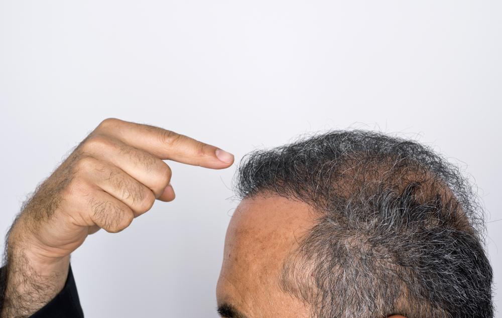 All about hair transplant techniques