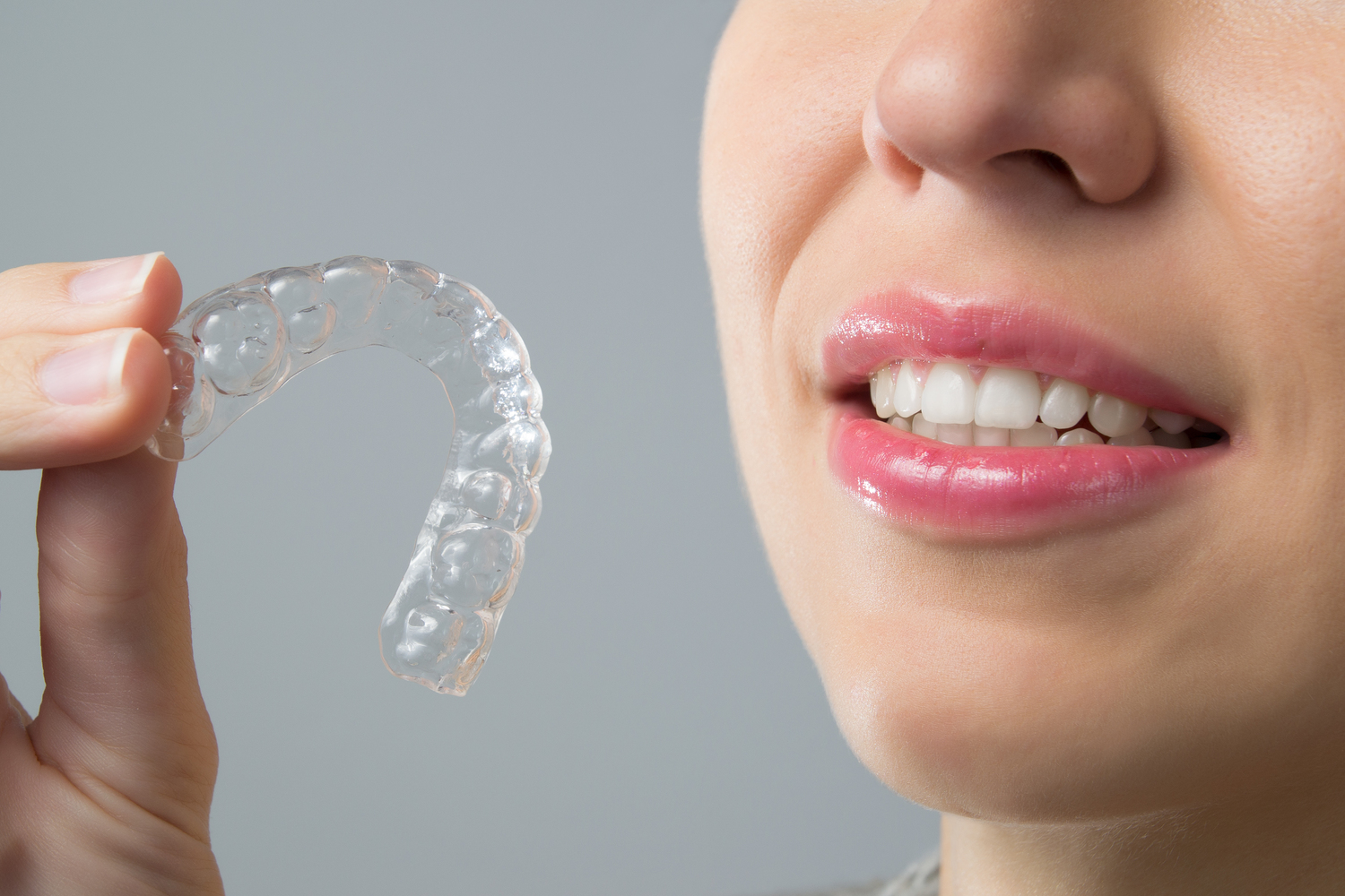 Top Benefits of Clear Aligners